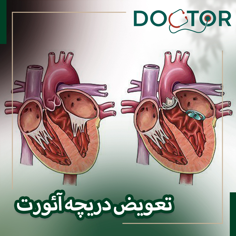 تعویض دریچه آئورت قلب بدون جراحی