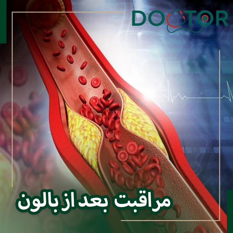 مراقبت های بعد از بالون زدن قلب