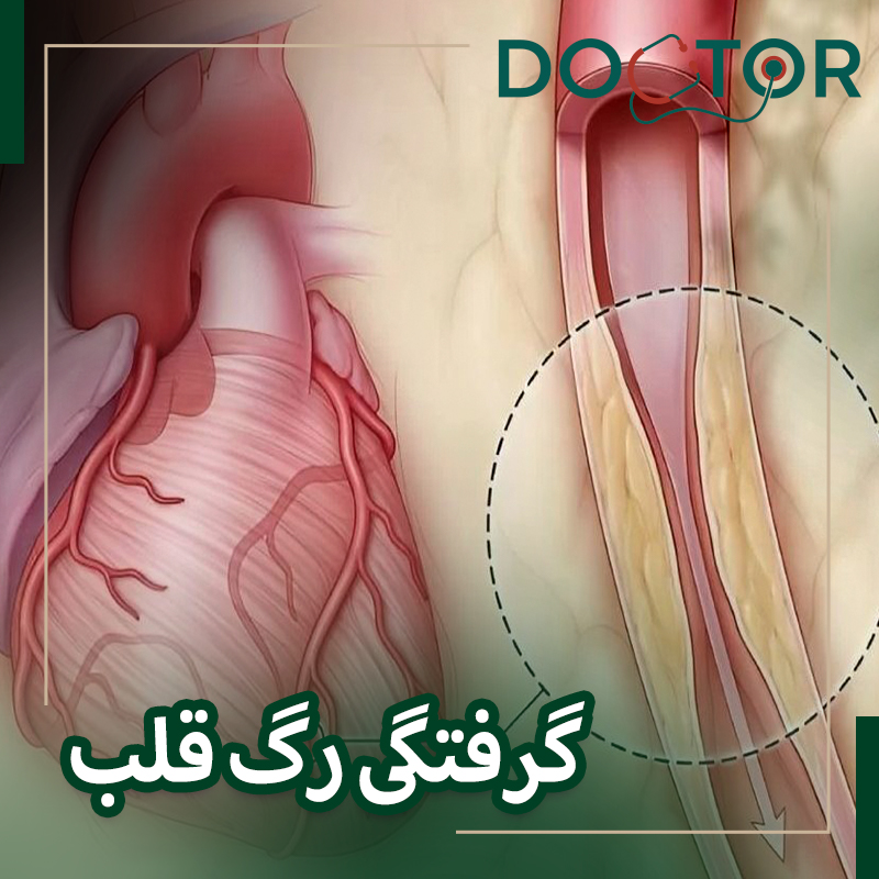 عوارض گرفتگی رگ قلب