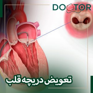 تعویض دریچه قلب بدون عمل باز