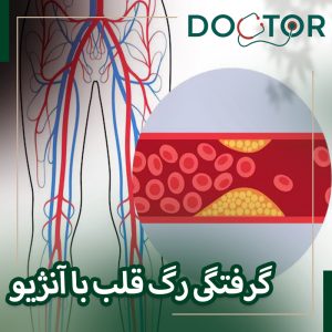 گرفتگی رگ قلب با آنژیو