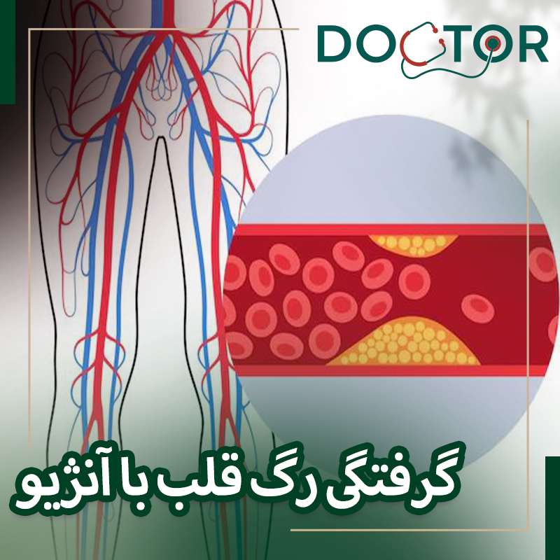 گرفتگی رگ قلب با آنژیو