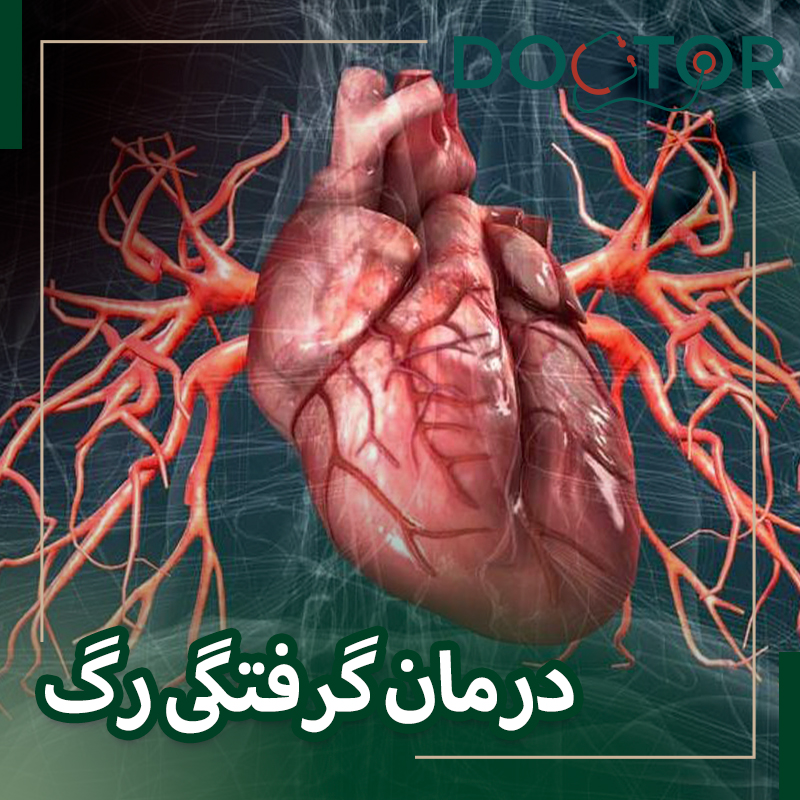 درمان گرفتگی رگ با سنگ شکن