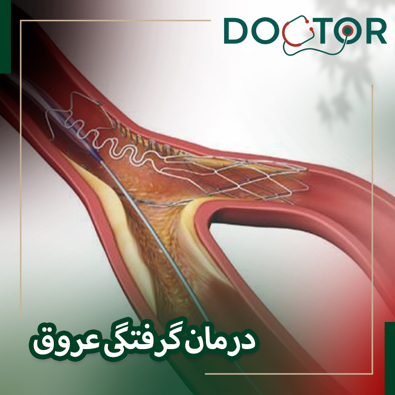 درمان گرفتگی عروق قلب بعد استنت با روش crush stenting