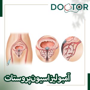 آمبولیزاسیون پروستات