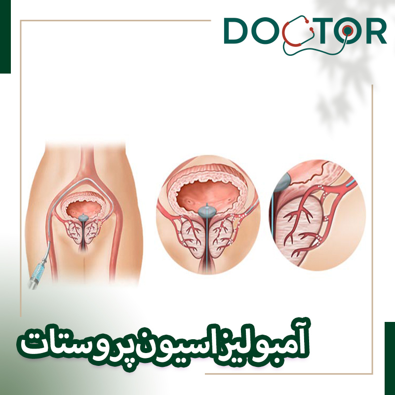 آمبولیزاسیون پروستات