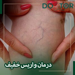 بهترین درمان واریس خفیف پا چیست؟