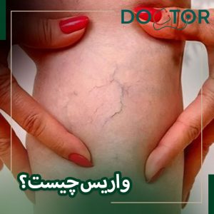 واریس چیست؟