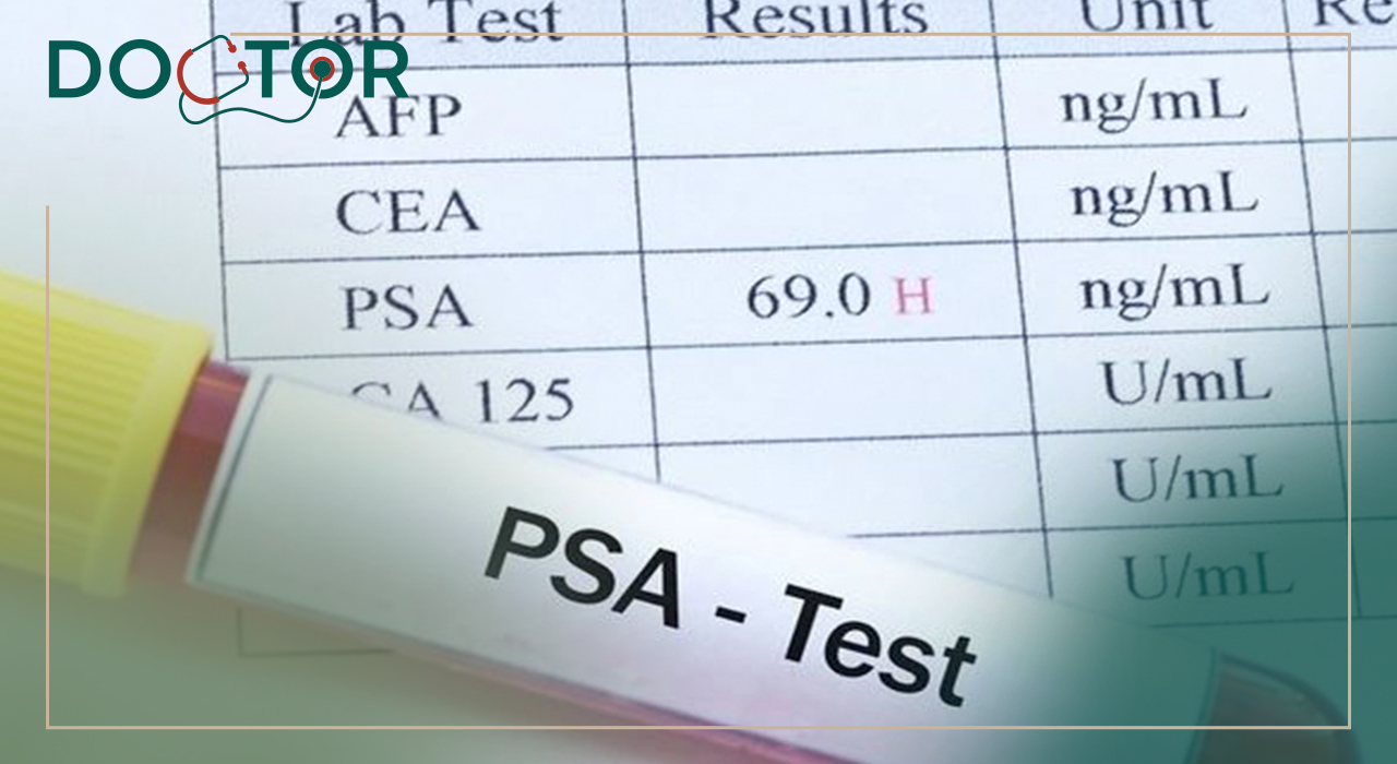 چه زمانی آزمایش PSA انجام میشود؟