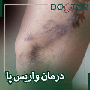 درمان واریس پا