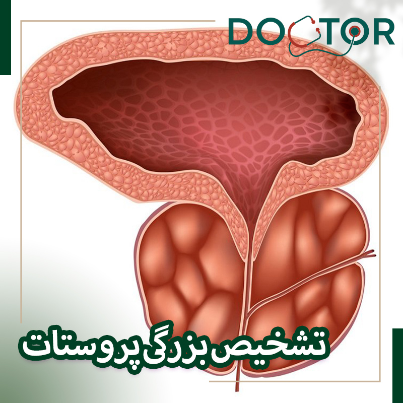 تشخیص بزرگی پروستات