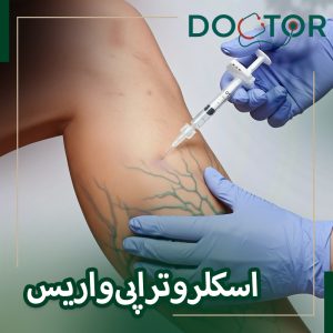 اسکلروتراپی واریس