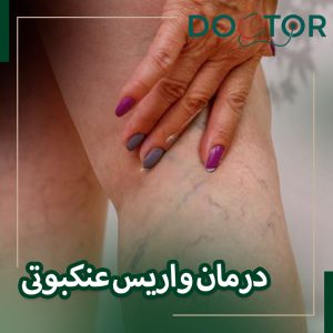 درمان واریس عنکبوتی