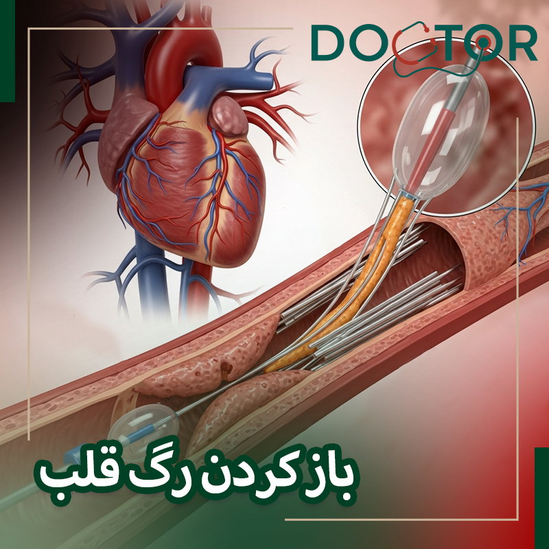 باز کردن رگ قلب بدون عمل قلب باز