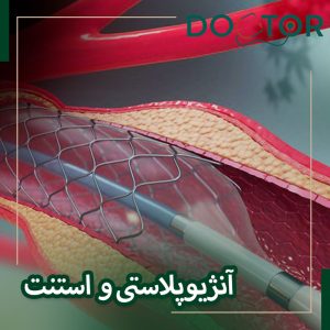 فرق آنژیوپلاستی با استنت و بالون
