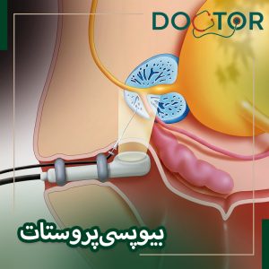 بیوپسی پروستات